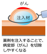 BioARC株式会社 生体吸収性高分子多糖体による革新的粘膜下注入材の開発